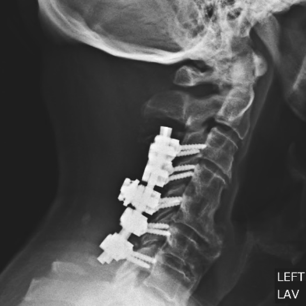 spine redo 1 Cervical Spine Fusion