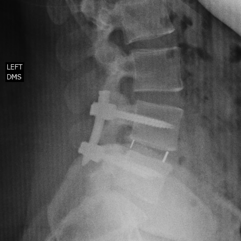 spine redo 2 Lumbar Spine Fusion